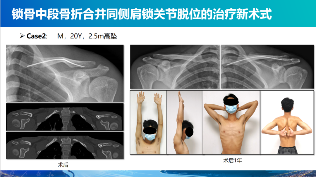 锁骨中段骨折合并同侧肩锁关节脱位新术式：弹性髓内钉+喙锁韧带重建、关节囊缝合