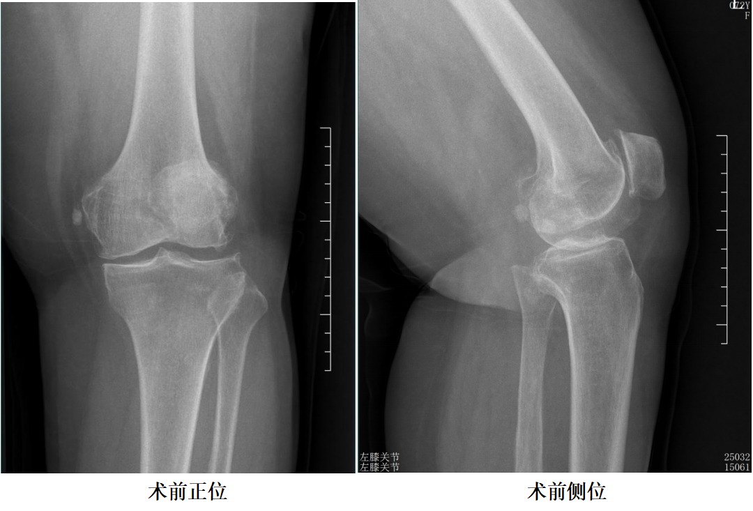 【手术视频】第三期：滑动平台单髁置换术(第三代胫骨截骨技术)