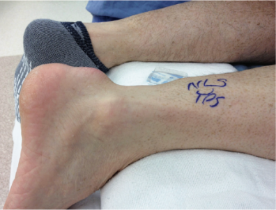 ​图文并茂：慢性跟腱断裂的最新治疗进展