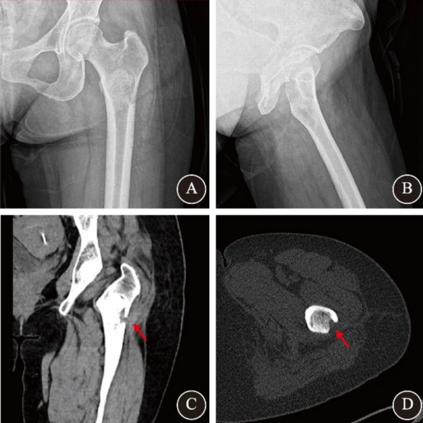 关节镜辅助单孔非同轴内镜手术治疗的前世今生