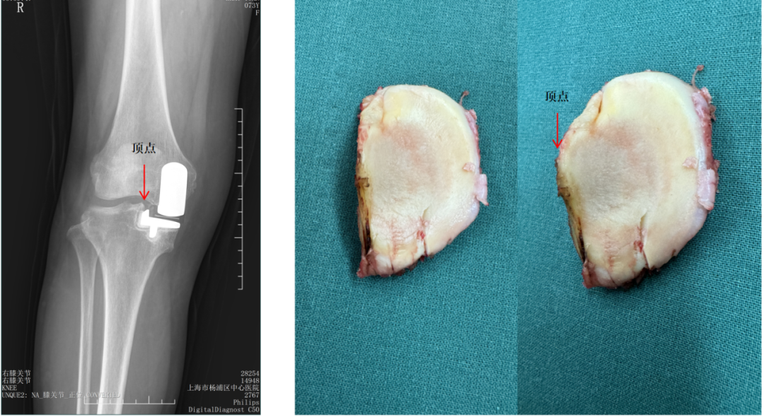 【读懂单髁】从读懂X-ray开始：胫骨假体位置解读