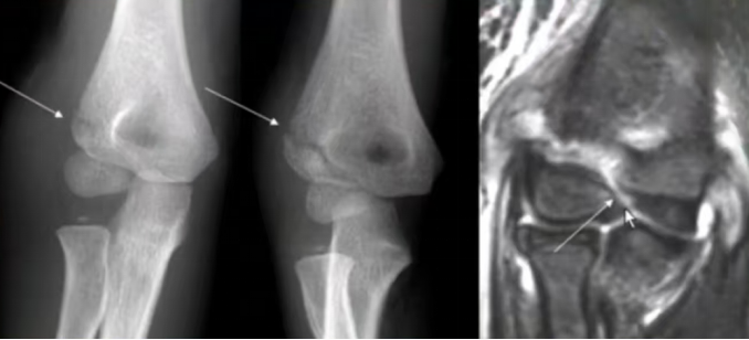 儿童肱骨外髁骨折的诊疗，本文全面总结！