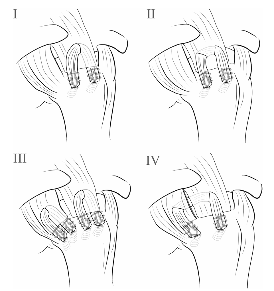 Hosentraeger技术：使用肱二头肌长头腱的关节镜下腱-腱置入术治疗不可修复肩袖撕裂