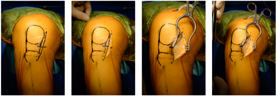 【滑动垫片单髁置换技术精讲系列】第一讲：麻醉、体位