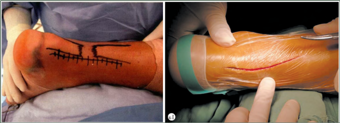 【手术技术】切开修复技术治疗急性跟腱断裂