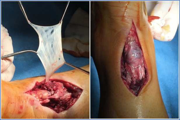 【手术技术】切开修复技术治疗急性跟腱断裂