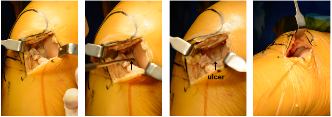 【滑动垫片单髁置换技术精讲系列】第一讲：麻醉、体位