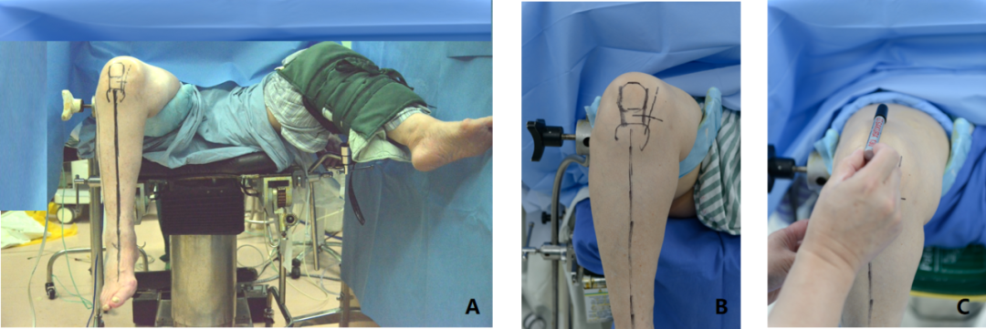 【滑动垫片单髁置换技术精讲系列】第一讲：麻醉、体位