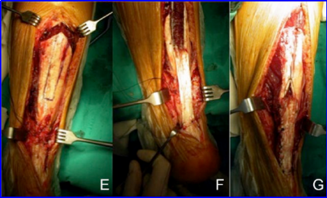 ​图文并茂：慢性跟腱断裂的最新治疗进展