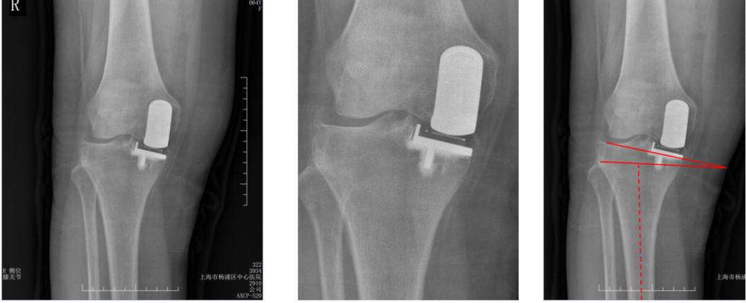 【读懂单髁】从读懂X-ray开始：胫骨假体位置解读