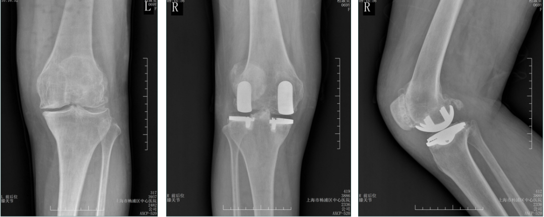【读懂单髁】从读懂X-ray开始：固定平台单髁假体(LINK®