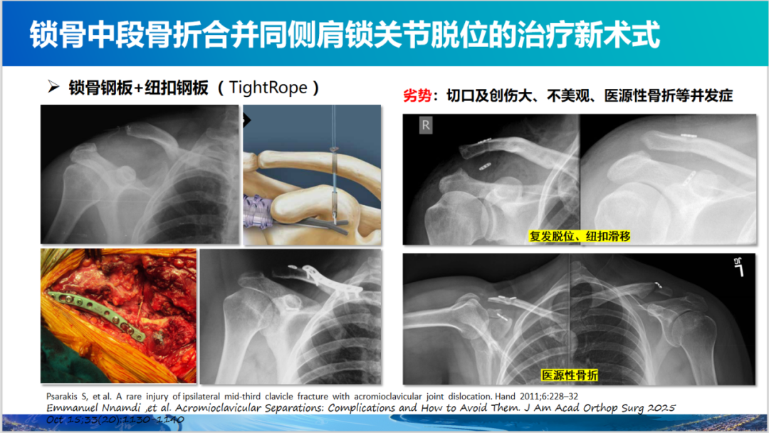 锁骨中段骨折合并同侧肩锁关节脱位新术式：弹性髓内钉+喙锁韧带重建、关节囊缝合