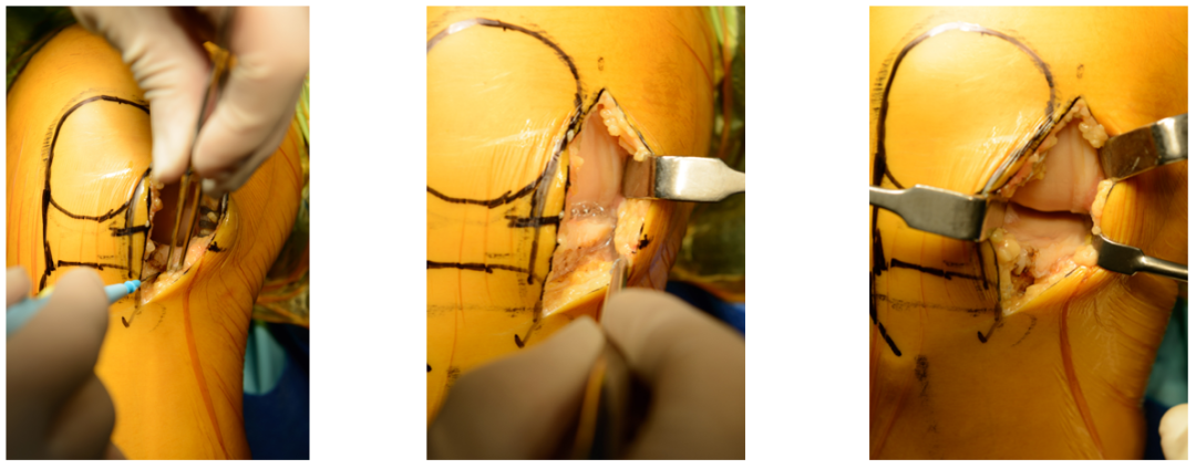 【滑动垫片单髁置换技术精讲系列】第一讲：麻醉、体位