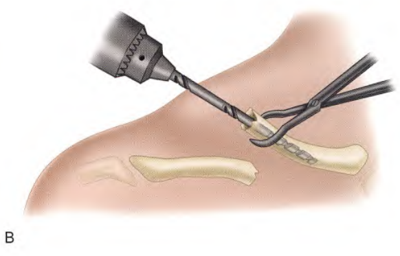 锁骨骨折：从分型到治疗的超全讲解，一文搞定！