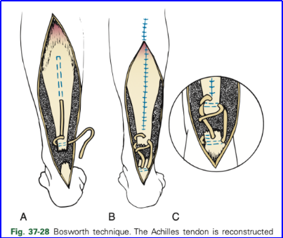 ​图文并茂：慢性跟腱断裂的最新治疗进展