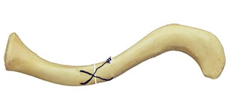 锁骨骨折：从分型到治疗的超全讲解，一文搞定！