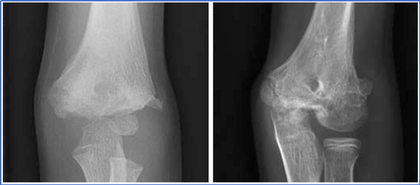 儿童肱骨外髁骨折的诊疗，本文全面总结！