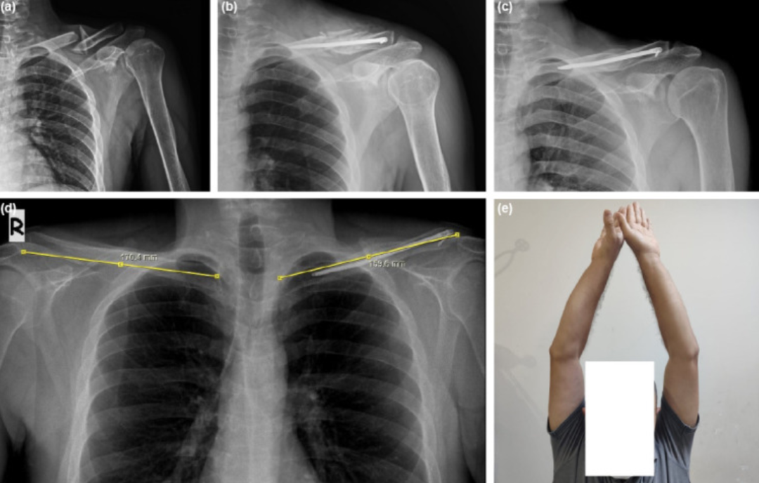 锁骨骨折：从分型到治疗的超全讲解，一文搞定！