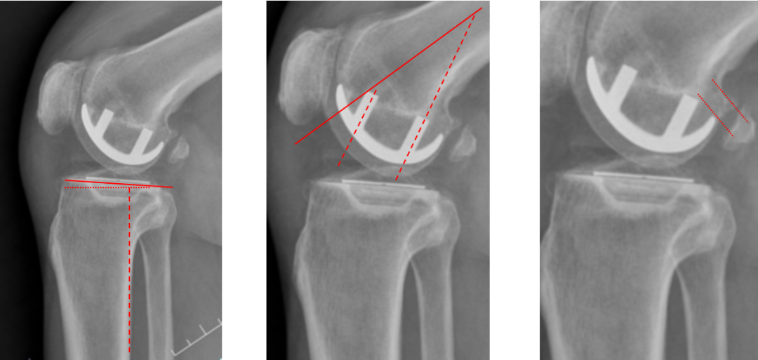【读懂单髁】从读懂X-ray开始：固定平台单髁假体(LINK®