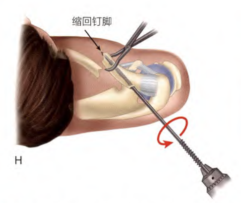 锁骨骨折：从分型到治疗的超全讲解，一文搞定！