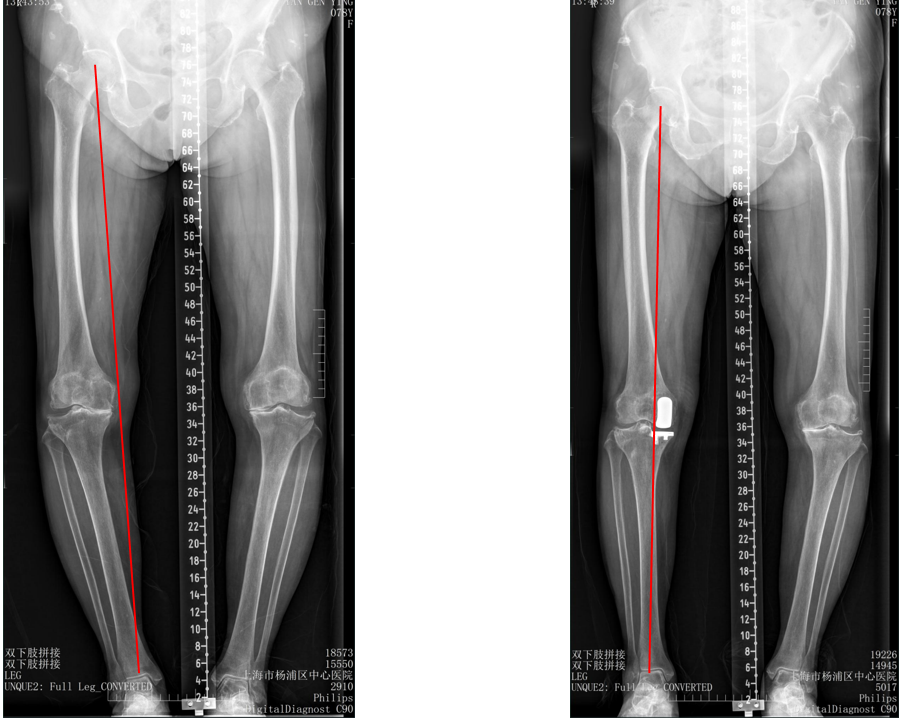 【读懂单髁】从读懂X-ray开始：固定平台单髁假体(SIGMA®