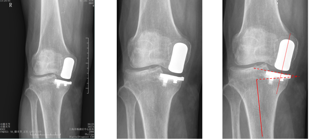 【读懂单髁】从读懂X-ray开始：固定平台单髁假体(SIGMA®