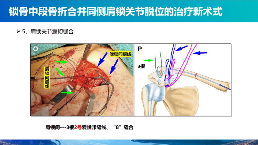 锁骨中段骨折合并同侧肩锁关节脱位新术式：弹性髓内钉+喙锁韧带重建、关节囊缝合
