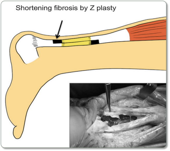 ​图文并茂：慢性跟腱断裂的最新治疗进展