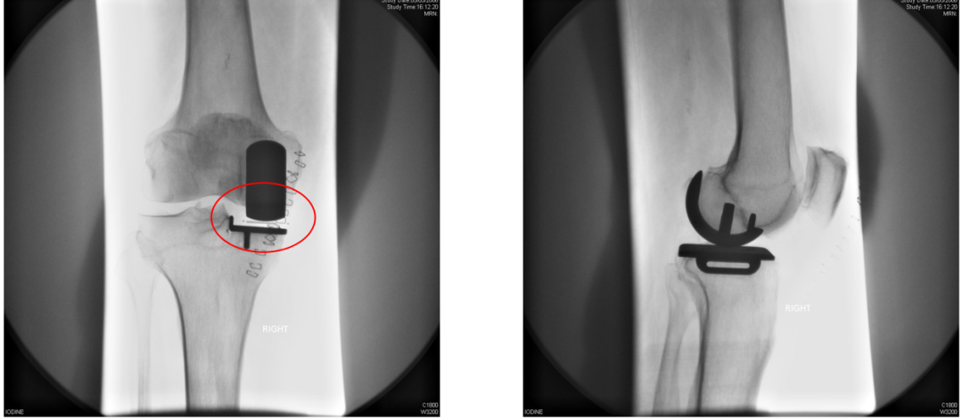 【读懂单髁】从读懂X-ray开始：胫骨假体位置解读