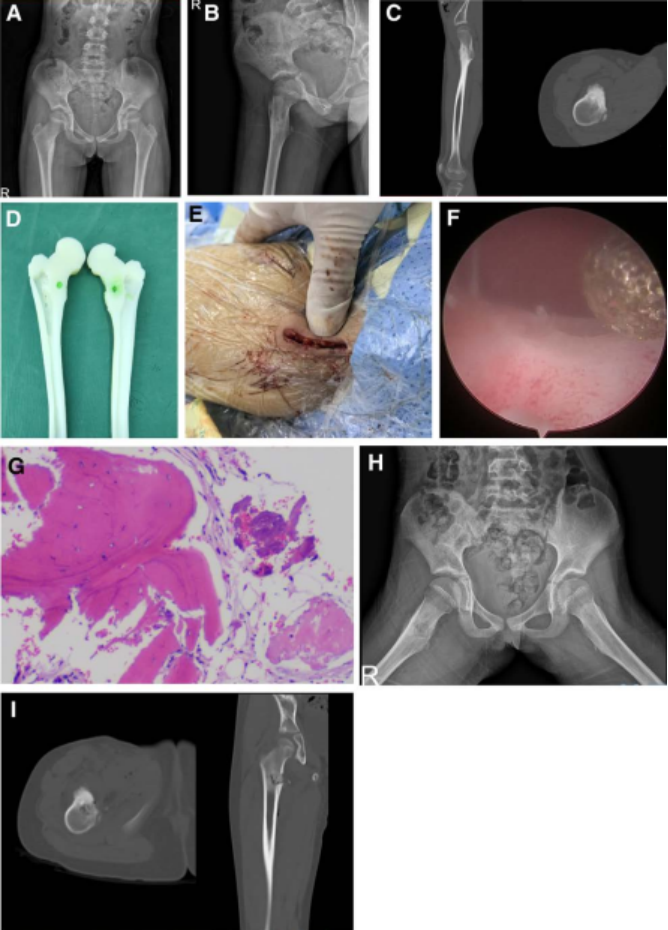 关节镜辅助单孔非同轴内镜手术治疗的前世今生