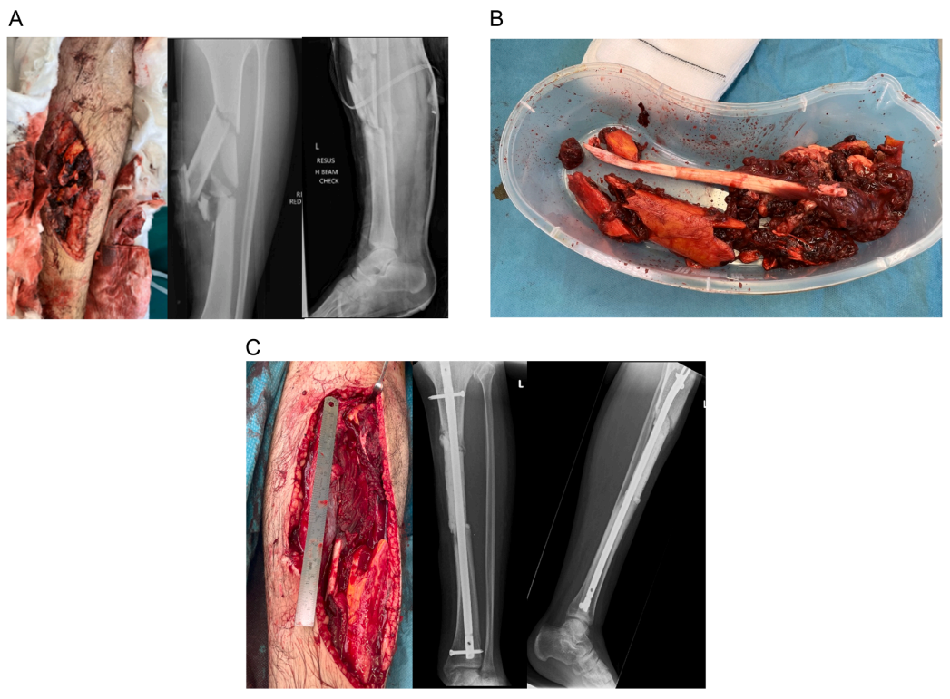 ​何时清创？如何减少感染？关于开放性骨折，你需要知道的方方面面！