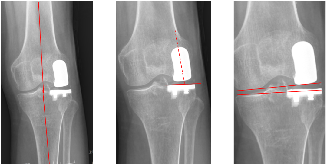 【读懂单髁】从读懂X-ray开始：固定平台单髁假体(SIGMA®
