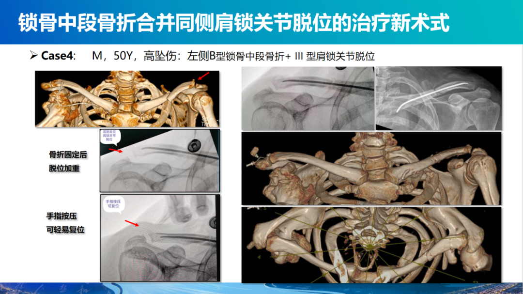 锁骨中段骨折合并同侧肩锁关节脱位新术式：弹性髓内钉+喙锁韧带重建、关节囊缝合