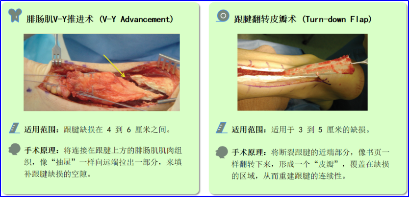 ​图文并茂：慢性跟腱断裂的最新治疗进展