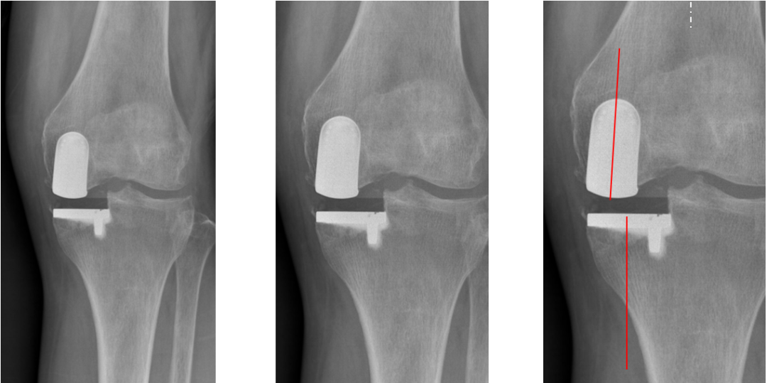 【读懂单髁】从读懂X-ray开始：固定平台单髁假体(LINK®