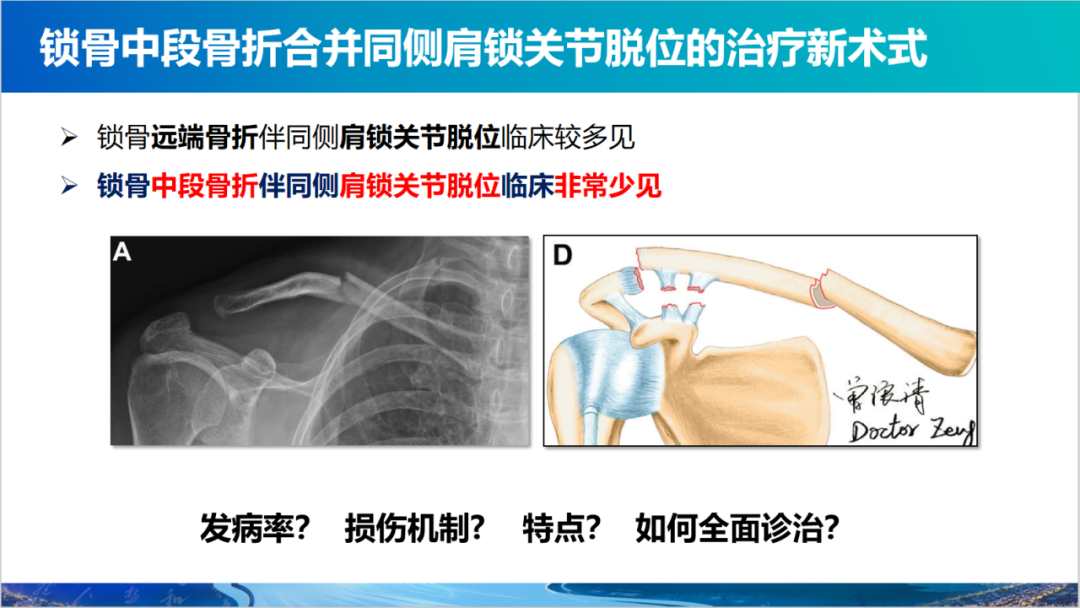 锁骨中段骨折合并同侧肩锁关节脱位新术式：弹性髓内钉+喙锁韧带重建、关节囊缝合
