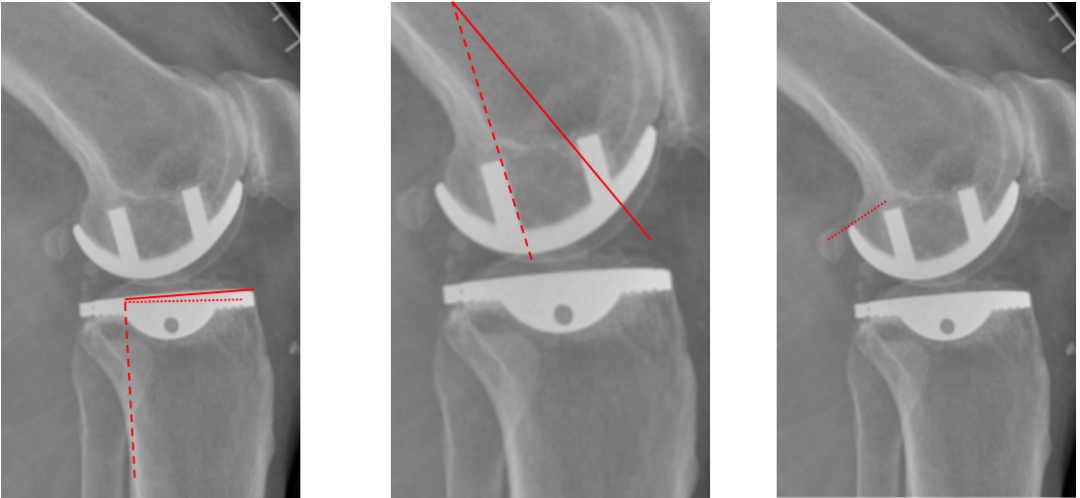 【读懂单髁】从读懂X-ray开始：固定平台单髁假体(LINK®