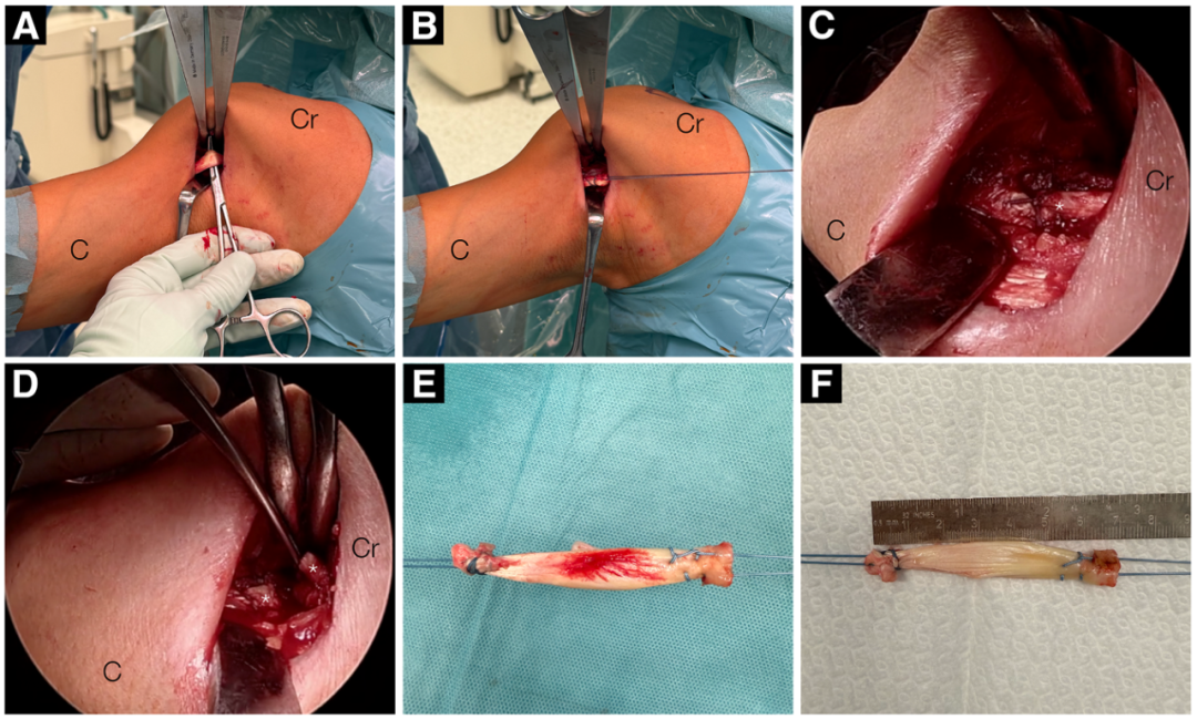 Hosentraeger技术：使用肱二头肌长头腱的关节镜下腱-腱置入术治疗不可修复肩袖撕裂