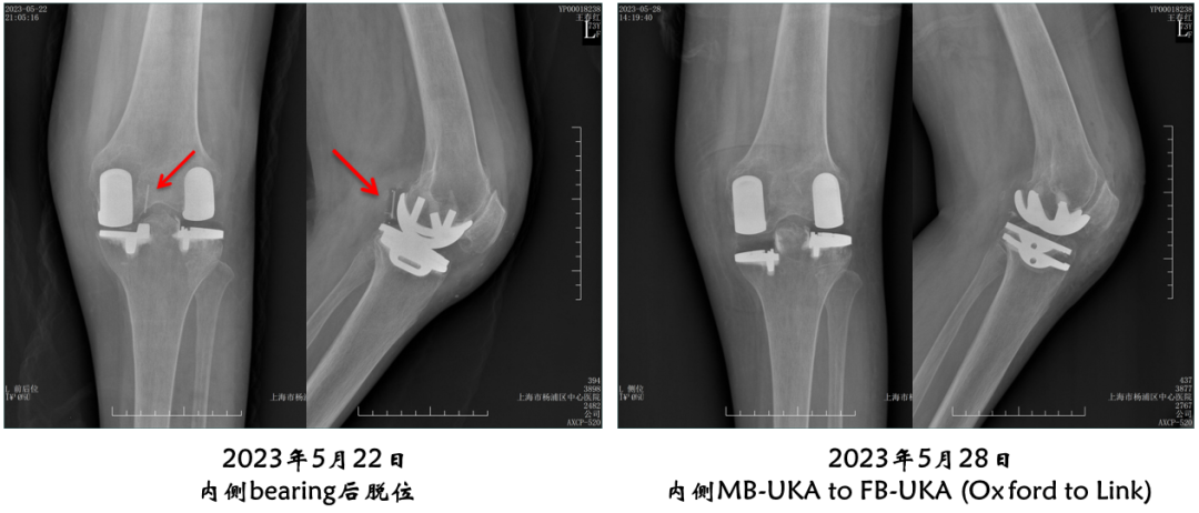 【读懂单髁】从读懂X-ray开始：术后摄片技术及垫片位置解读