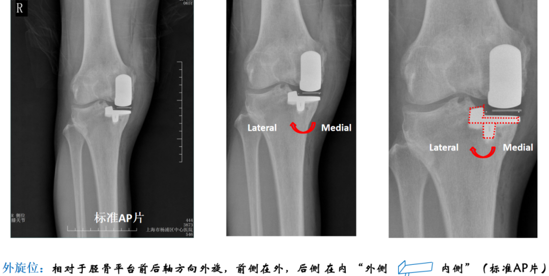 【读懂单髁】从读懂X-ray开始：胫骨假体位置解读