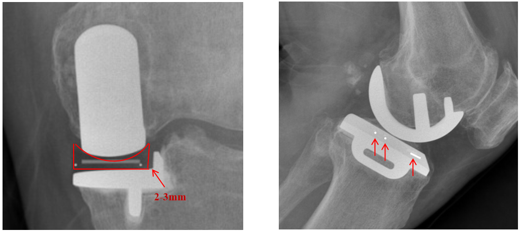 【读懂单髁】从读懂X-ray开始：术后摄片技术及垫片位置解读