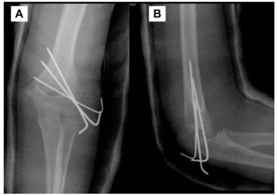 儿童肱骨外髁骨折的诊疗，本文全面总结！