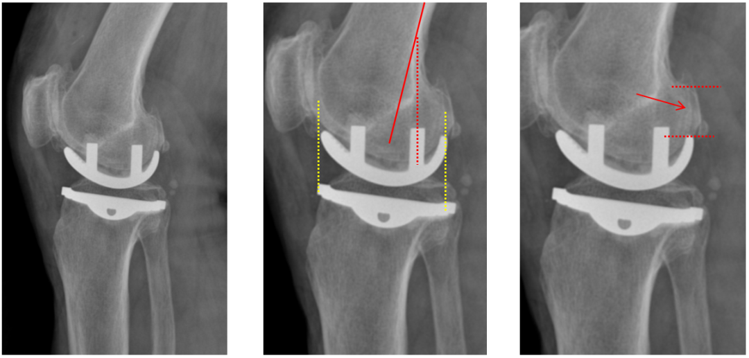 【读懂单髁】从读懂X-ray开始：固定平台单髁假体(LINK®