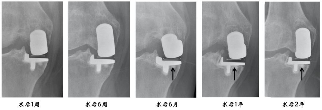 【读懂单髁】从读懂X-ray开始：胫骨假体位置解读