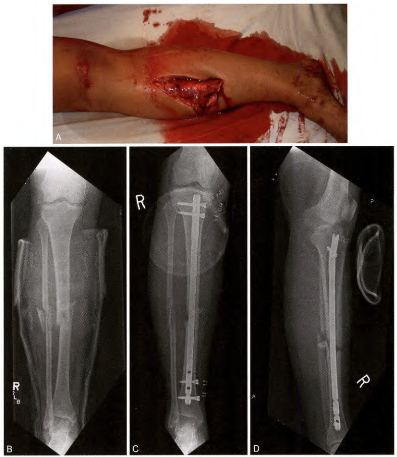 ​何时清创？如何减少感染？关于开放性骨折，你需要知道的方方面面！