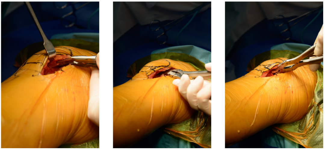 【滑动垫片单髁置换技术精讲系列】第一讲：麻醉、体位