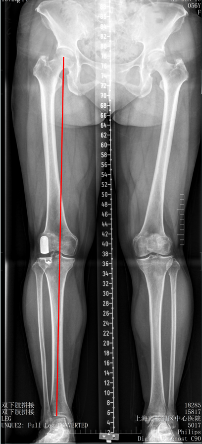 【读懂单髁】从读懂X-ray开始：固定平台单髁假体(LINK®