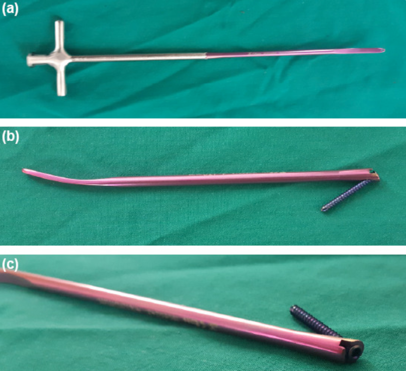 锁骨骨折：从分型到治疗的超全讲解，一文搞定！