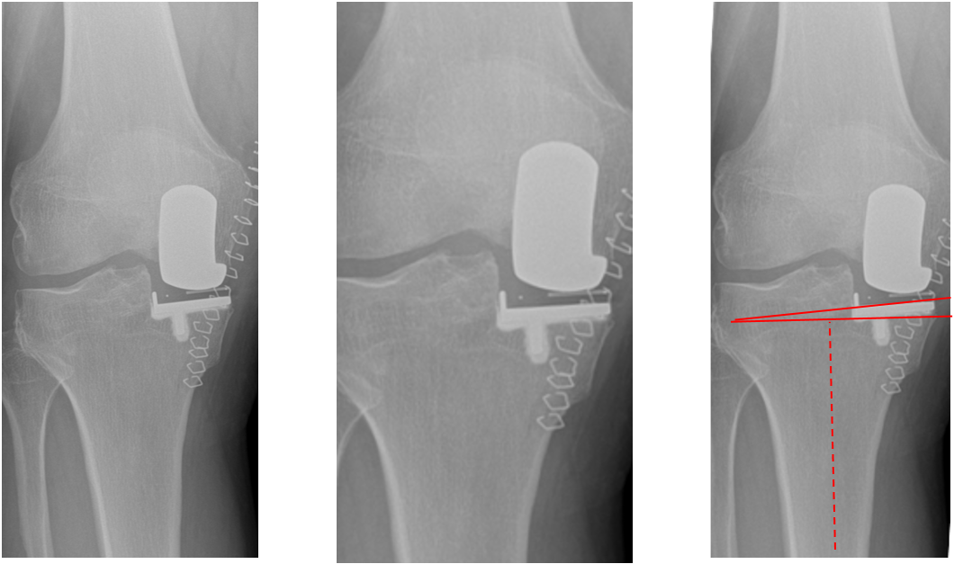 【读懂单髁】从读懂X-ray开始：胫骨假体位置解读