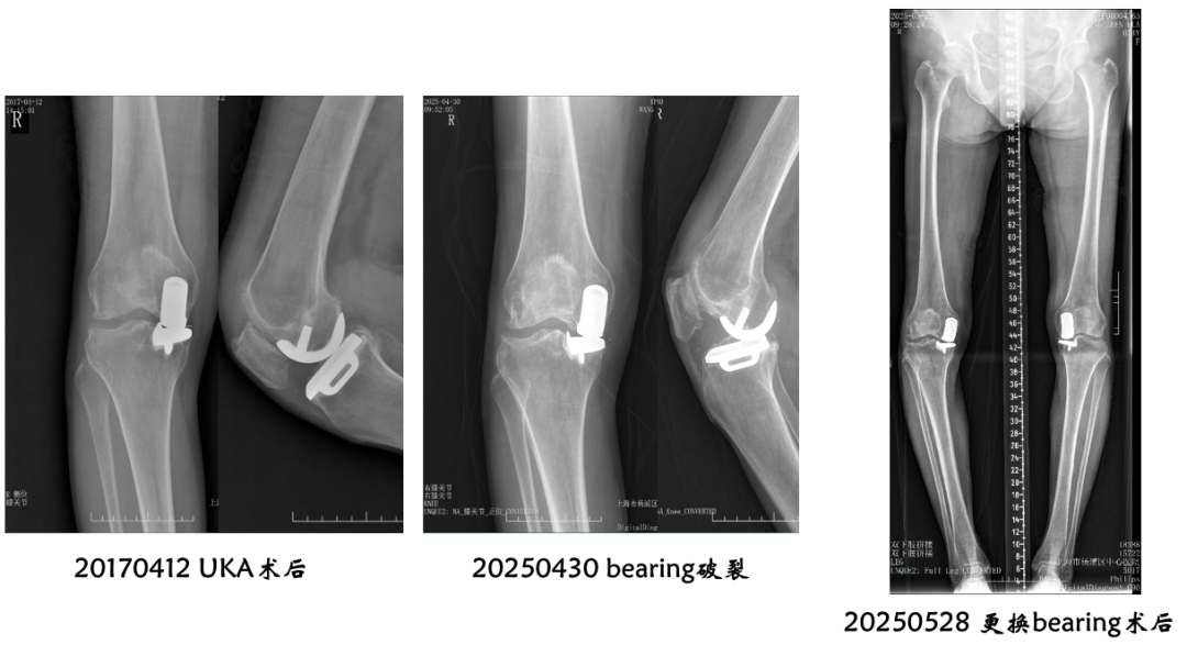 【读懂单髁】从读懂X-ray开始：术后摄片技术及垫片位置解读